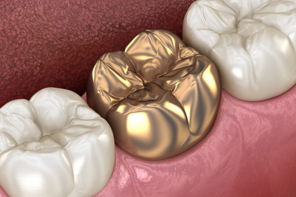 Golden,Crown,Molar,Tooth,Assembly,Process.,Medically,Accurate,3d,Illustration