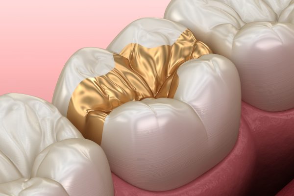 Golden,Inlay,Crown,Fixation,Over,Tooth.,Medically,Accurate,3d,Illustration